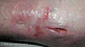 ALHYDRAN Case Study: Chronical wound - Before