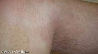 ALHYDRAN Case Study: Second degree burn - After