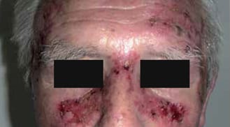 ALHYDRAN Case Study: Erosive skin - Before