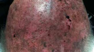 ALHYDRAN Case Study: Multiple actinic keratosis - Before