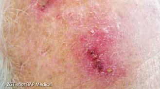 ALHYDRAN Case Study: Actinic keratosis - Before