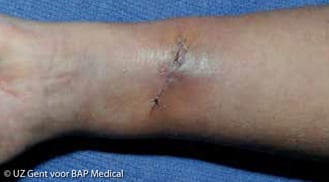 ALHYDRAN Case Study: Surgery scar - Before