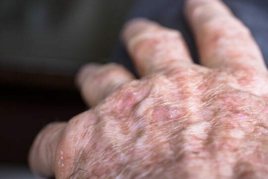 Actinic keratosis hand